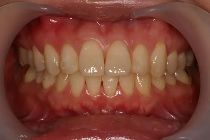 Teeth whitening: frontal tooth-colour comparison at Lime Tree Dental Hospital. Lime Tree Dental Hospital — Teeth whitening: frontal tooth-colour comparison. Before treatment.