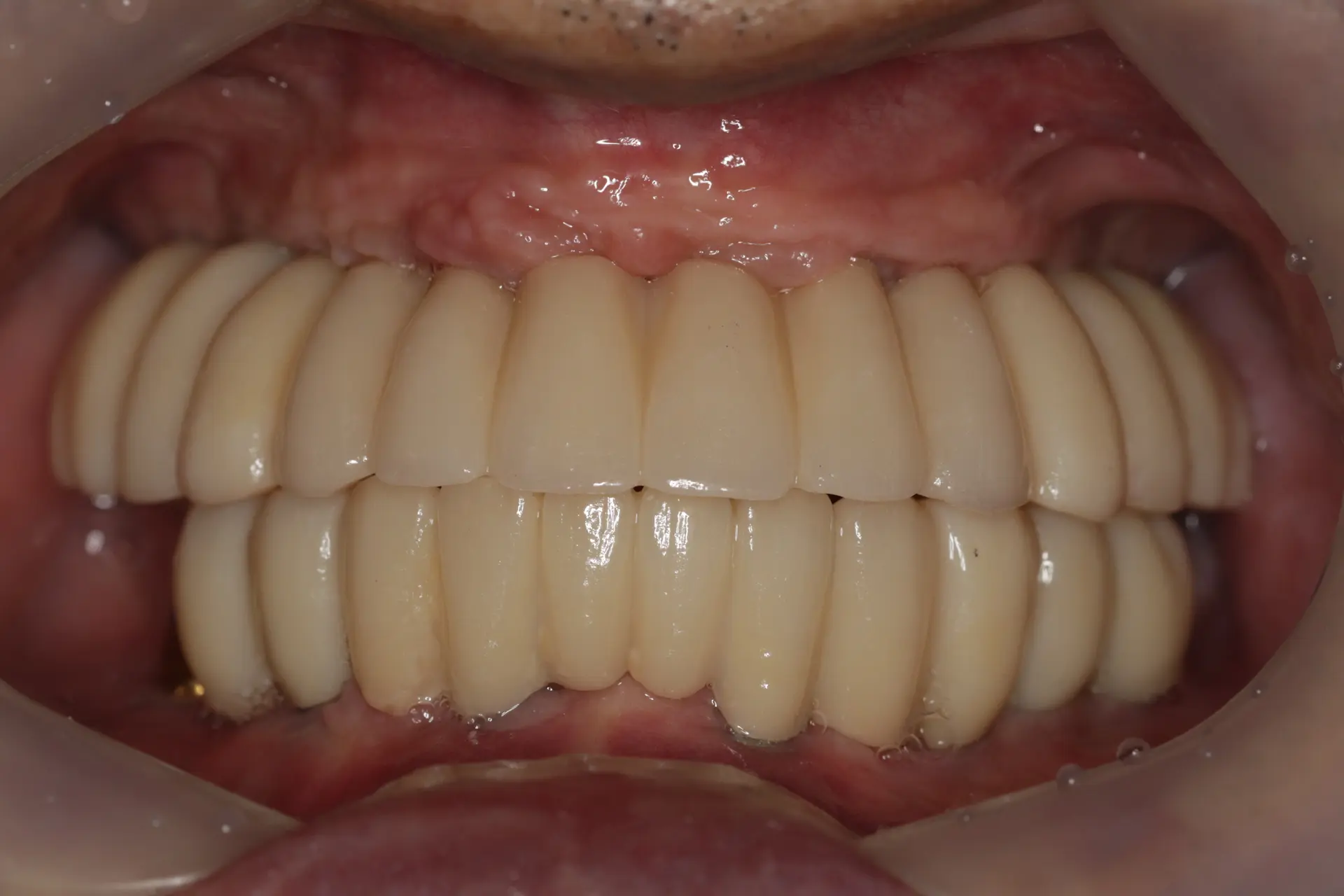 Full-mouth implants: dental views and X-rays at Lime Tree Dental Hospital. Lime Tree Dental Hospital — Full-mouth implants: dental views and X-rays. After: upper and lower replacement teeth.