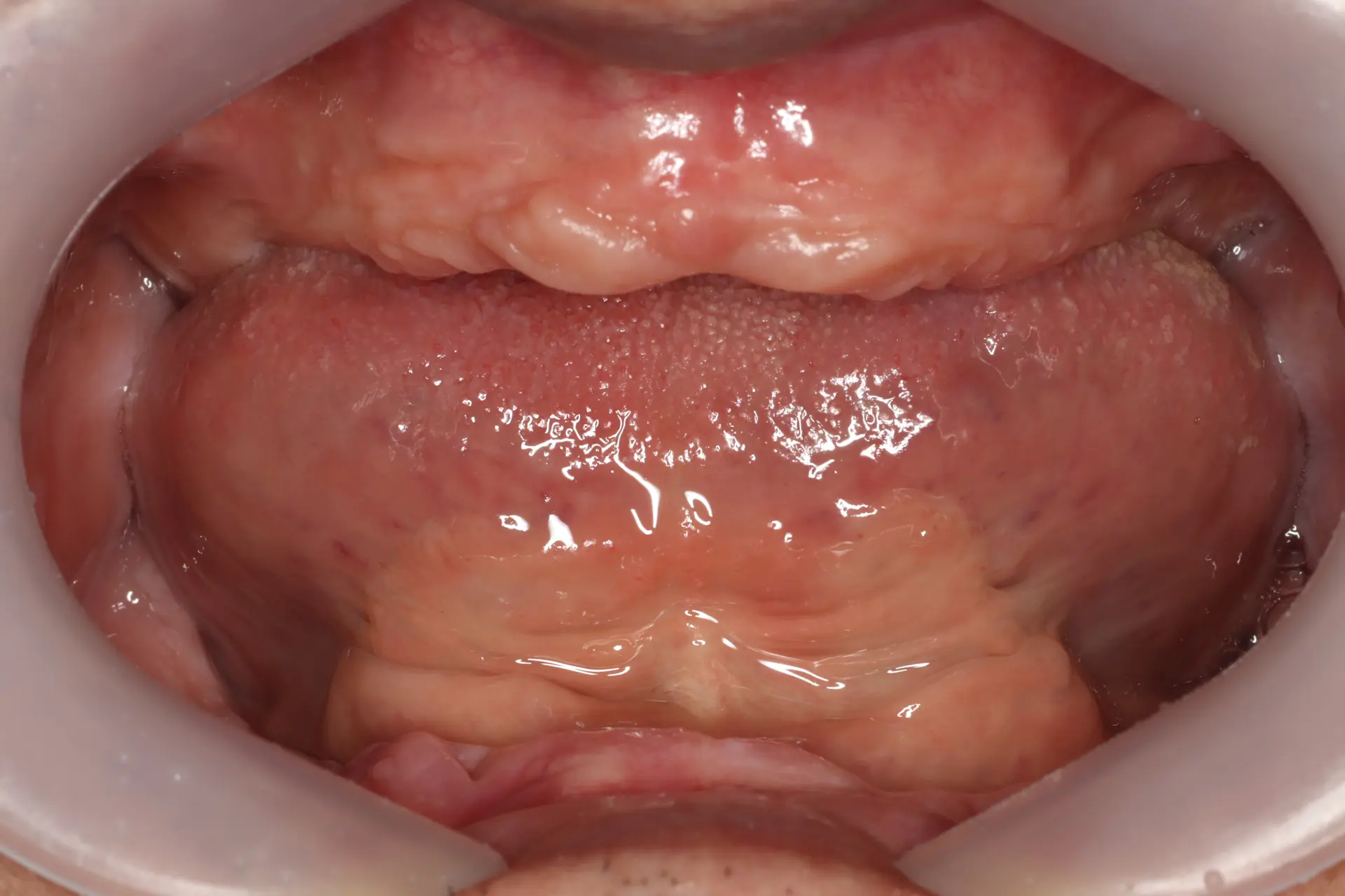 Full-mouth implants: dental views and X-rays at Lime Tree Dental Hospital. Lime Tree Dental Hospital — Full-mouth implants: dental views and X-rays. Before: upper and lower gums without visible natural teeth.