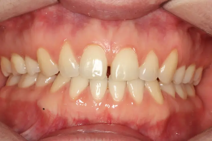 Veneers: a visible gap between upper front teeth at Lime Tree Dental Hospital. Lime Tree Dental Hospital — Veneers: a visible gap between upper front teeth. Before treatment.