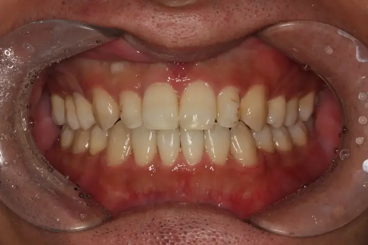 Veneers: discoloured teeth and shade variation at Lime Tree Dental Hospital. Lime Tree Dental Hospital — Veneers: discoloured teeth and shade variation. Before treatment.