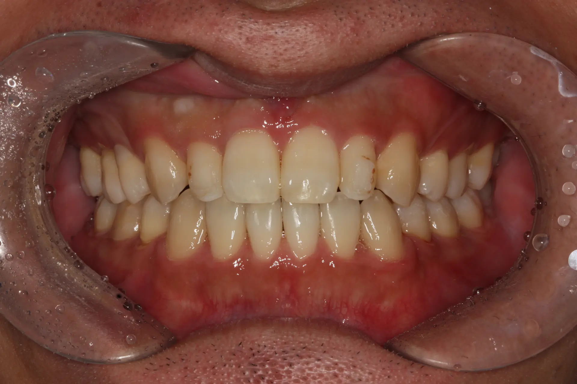 Veneers: discoloured teeth and shade variation at Lime Tree Dental Hospital. Lime Tree Dental Hospital — Veneers: discoloured teeth and shade variation. Before treatment.