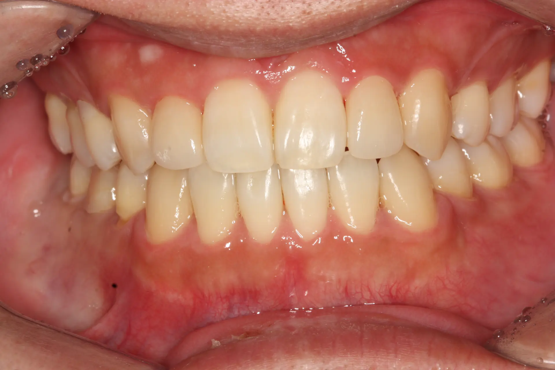Veneers: discoloured teeth and shade variation at Lime Tree Dental Hospital. Lime Tree Dental Hospital — Veneers: discoloured teeth and shade variation. After treatment.