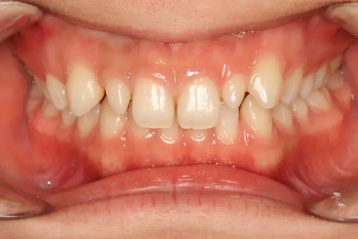 Veneers: small upper front teeth and proportions at Lime Tree Dental Hospital. Lime Tree Dental Hospital — Veneers: small upper front teeth and proportions. Before treatment.