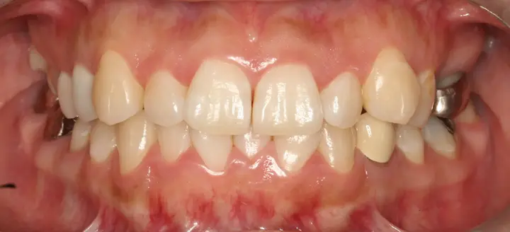 Veneers: front-tooth shape and surface detail at Lime Tree Dental Hospital. Lime Tree Dental Hospital — Veneers: front-tooth shape and surface detail. Before treatment.