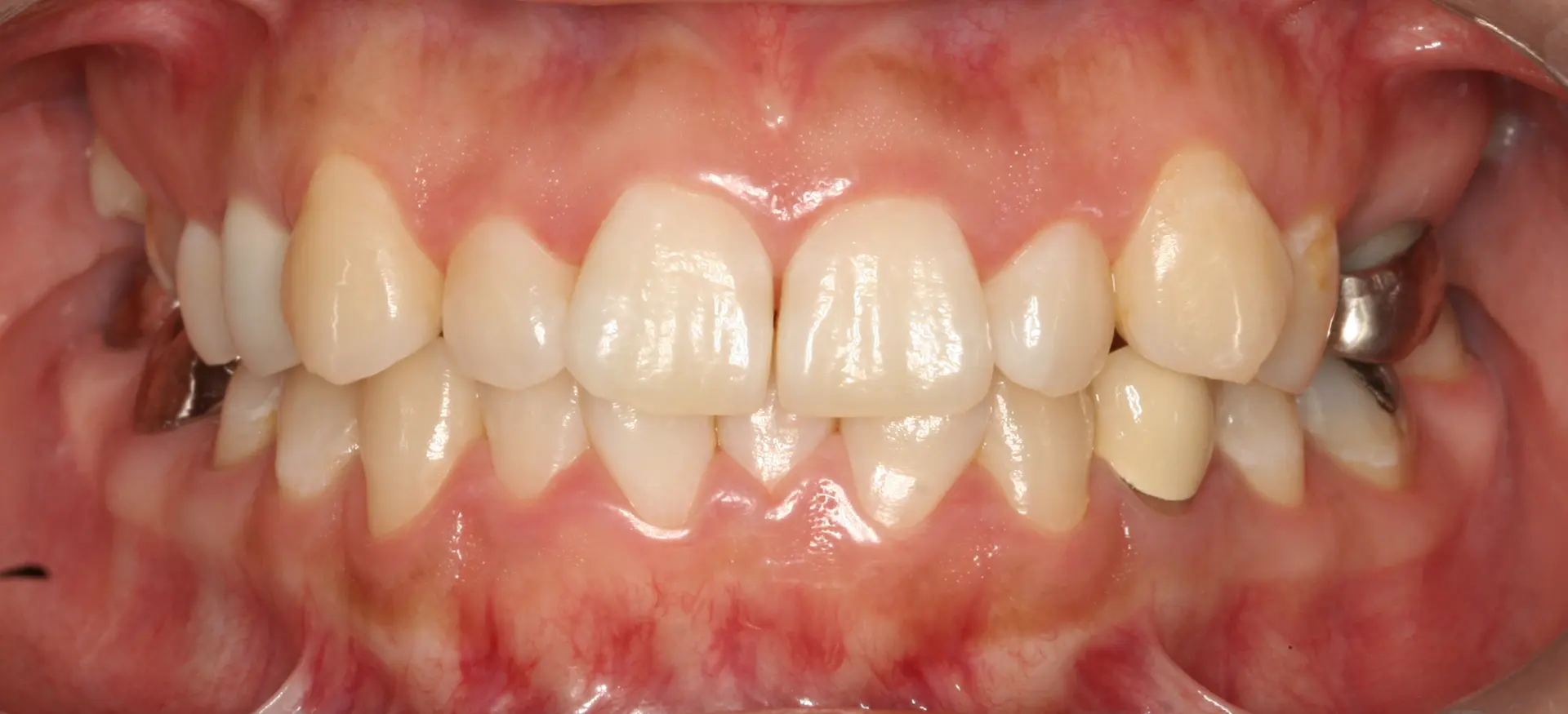 Veneers: front-tooth shape and surface detail at Lime Tree Dental Hospital. Lime Tree Dental Hospital — Veneers: front-tooth shape and surface detail. Before treatment.