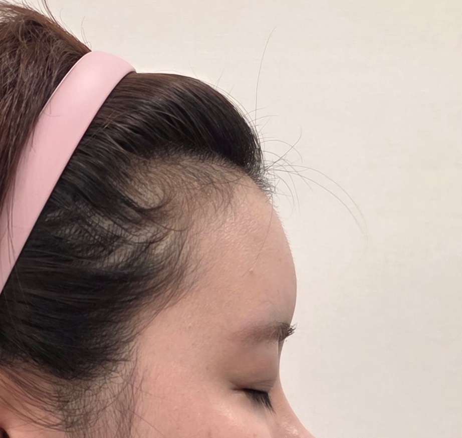 Forehead — profile photo comparison at Liyan Clinic. Liyan Clinic, Jeju: forehead — profile photo comparison. First photograph in the supplied sequence; treatment and timing were not provided.
