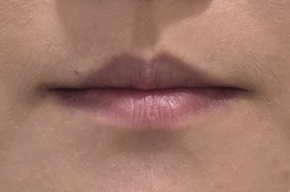 Lips — close-up photo comparison at Liyan Clinic. Liyan Clinic, Jeju: lips — close-up photo comparison. First photograph in the supplied sequence; treatment and timing were not provided.