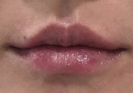Lips — close-up photo comparison at Liyan Clinic. Liyan Clinic, Jeju: lips — close-up photo comparison. Second photograph in the supplied sequence; treatment and timing were not provided.