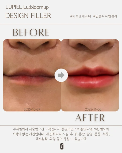 Lu:bloomup lip filler: shape and outline at Lupiel Clinic. Before on the left, dated 27 October 2025; after on the right, dated 6 November 2025. Close-up of the lip border, Cupid’s bow and lower lip.
