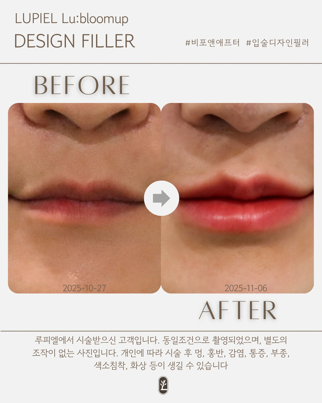 Lu:bloomup lip filler: shape and outline at Lupiel Clinic. Before on the left, dated 27 October 2025; after on the right, dated 6 November 2025. Close-up of the lip border, Cupid’s bow and lower lip.