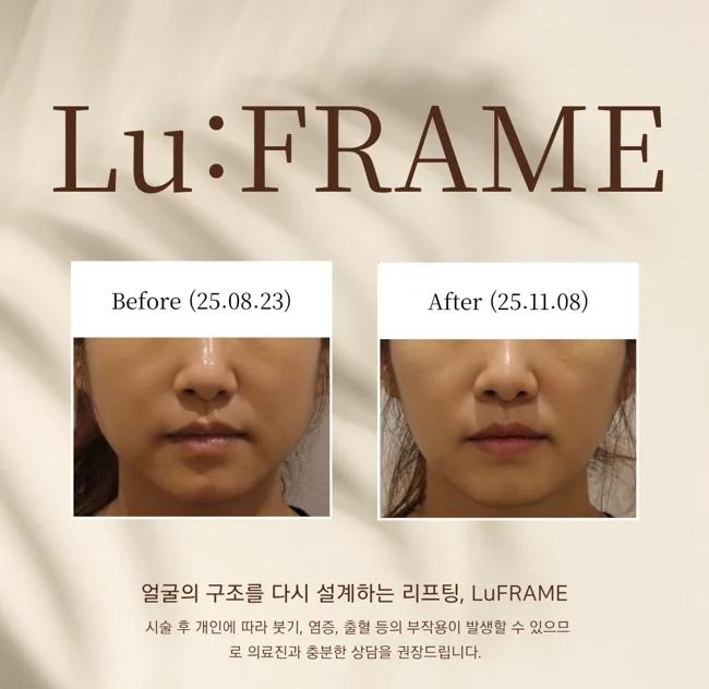 Lu:FRAME lifting: lower-face comparison at Lupiel Clinic. Before on the left, dated 23 August 2025; after on the right, dated 8 November 2025. Front view of the cheeks, mouth, chin and jawline.