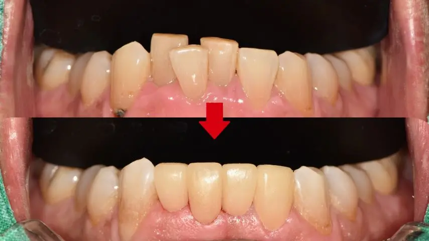 Lower front teeth: uneven edges at Magok Pureunmaeum Dental Clinic. Magok Pureunmaeum Dental Clinic — Lower front teeth: uneven edges. Top and bottom clinical views, linked by the clinic’s downward arrow.