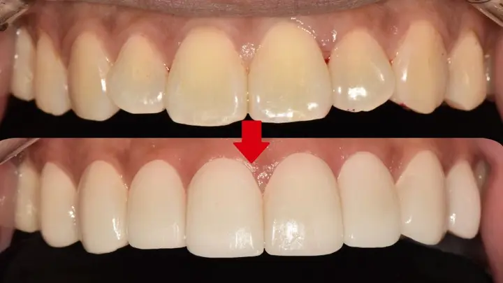 Upper front teeth: edge detail and colour at Magok Pureunmaeum Dental Clinic. Magok Pureunmaeum Dental Clinic — Upper front teeth: edge detail and colour. Top and bottom clinical views, linked by the clinic’s downward arrow.