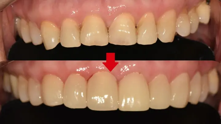 Upper front teeth: shade and contour at Magok Pureunmaeum Dental Clinic. Magok Pureunmaeum Dental Clinic — Upper front teeth: shade and contour. Top and bottom clinical views, linked by the clinic’s downward arrow.