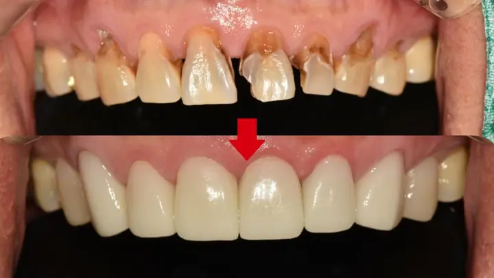 Upper front teeth: surface and outline changes at Magok Pureunmaeum Dental Clinic. Magok Pureunmaeum Dental Clinic — Upper front teeth: surface and outline changes. Top and bottom clinical views, linked by the clinic’s downward arrow.
