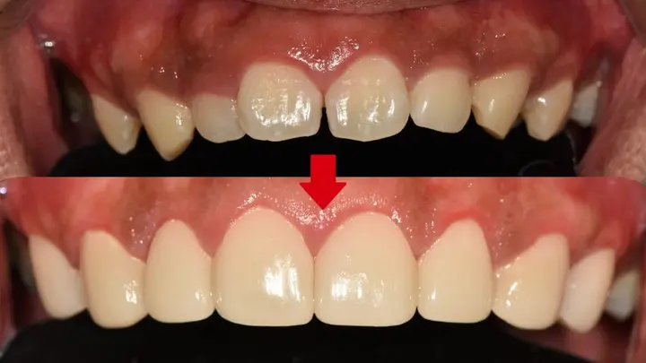 Upper front teeth: a more even outline at Magok Pureunmaeum Dental Clinic. Magok Pureunmaeum Dental Clinic — Upper front teeth: a more even outline. Top and bottom clinical views, linked by the clinic’s downward arrow.