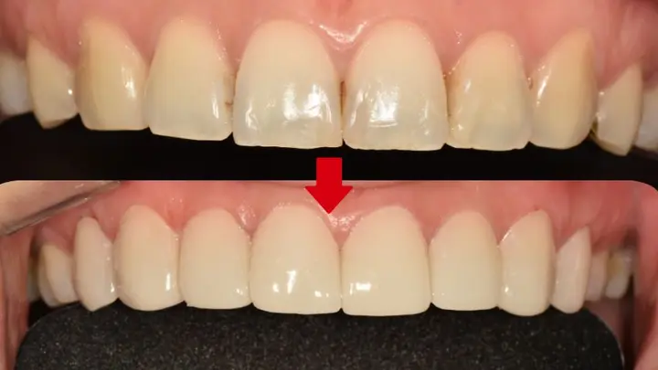 Upper front teeth: frontal detail at Magok Pureunmaeum Dental Clinic. Magok Pureunmaeum Dental Clinic — Upper front teeth: frontal detail. Top and bottom clinical views, linked by the clinic’s downward arrow.