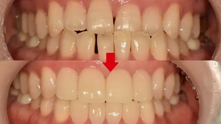 Upper and lower front teeth: spacing and shape at Magok Pureunmaeum Dental Clinic. Magok Pureunmaeum Dental Clinic — Upper and lower front teeth: spacing and shape. Top and bottom clinical views, linked by the clinic’s downward arrow.