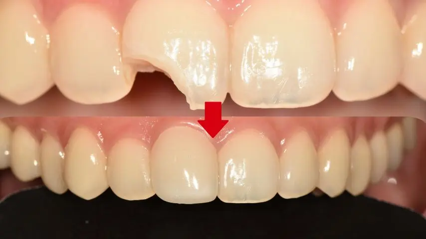 Chipped upper front tooth: edge comparison at Magok Pureunmaeum Dental Clinic. Magok Pureunmaeum Dental Clinic — Chipped upper front tooth: edge comparison. Top and bottom clinical views, linked by the clinic’s downward arrow.