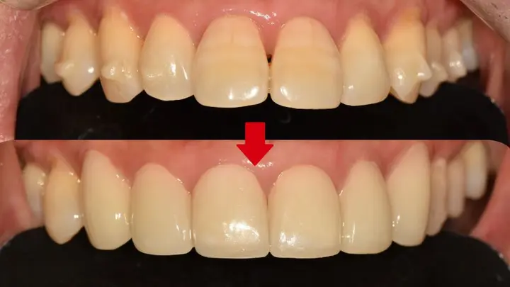 Upper front teeth: close-up and wider views at Magok Pureunmaeum Dental Clinic. Magok Pureunmaeum Dental Clinic — Upper front teeth: close-up and wider views. Top and bottom clinical views, linked by the clinic’s downward arrow.