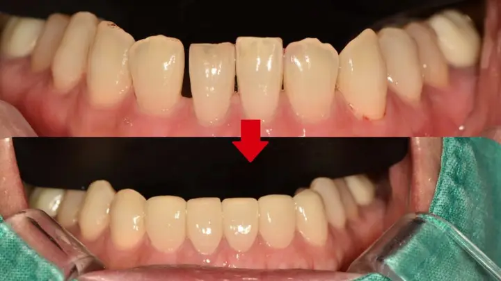 Lower front teeth: visible spacing at Magok Pureunmaeum Dental Clinic. Magok Pureunmaeum Dental Clinic — Lower front teeth: visible spacing. Top and bottom clinical views, linked by the clinic’s downward arrow.