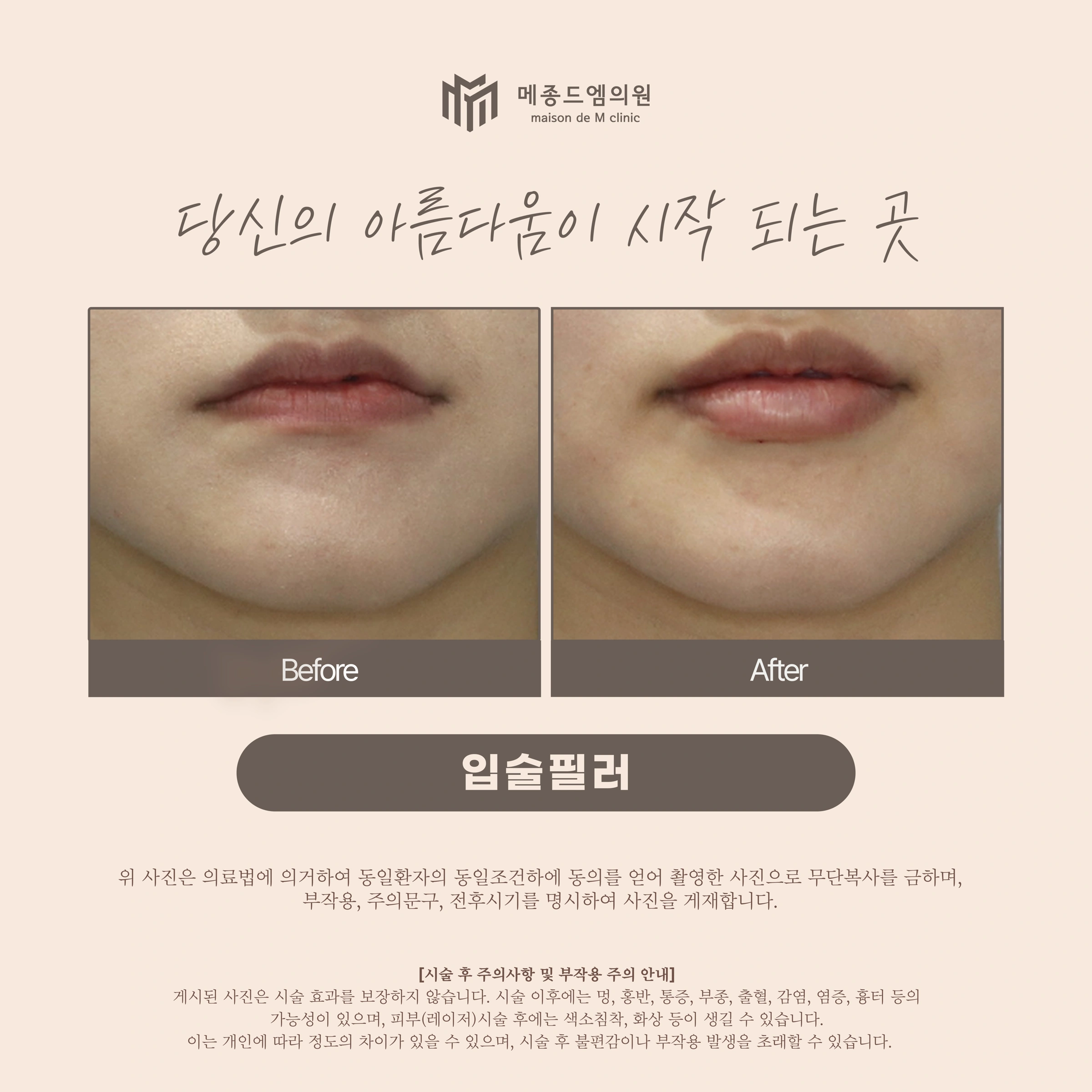 Lip filler — close-up comparison at Maison de M Clinic. Maison de M Clinic: Lip filler — close-up comparison. Before on the left; after on the right. The close-up board shows the lips and surrounding mouth area before and after filler. Mouth position and lighting vary; the follow-up interval is not stated.