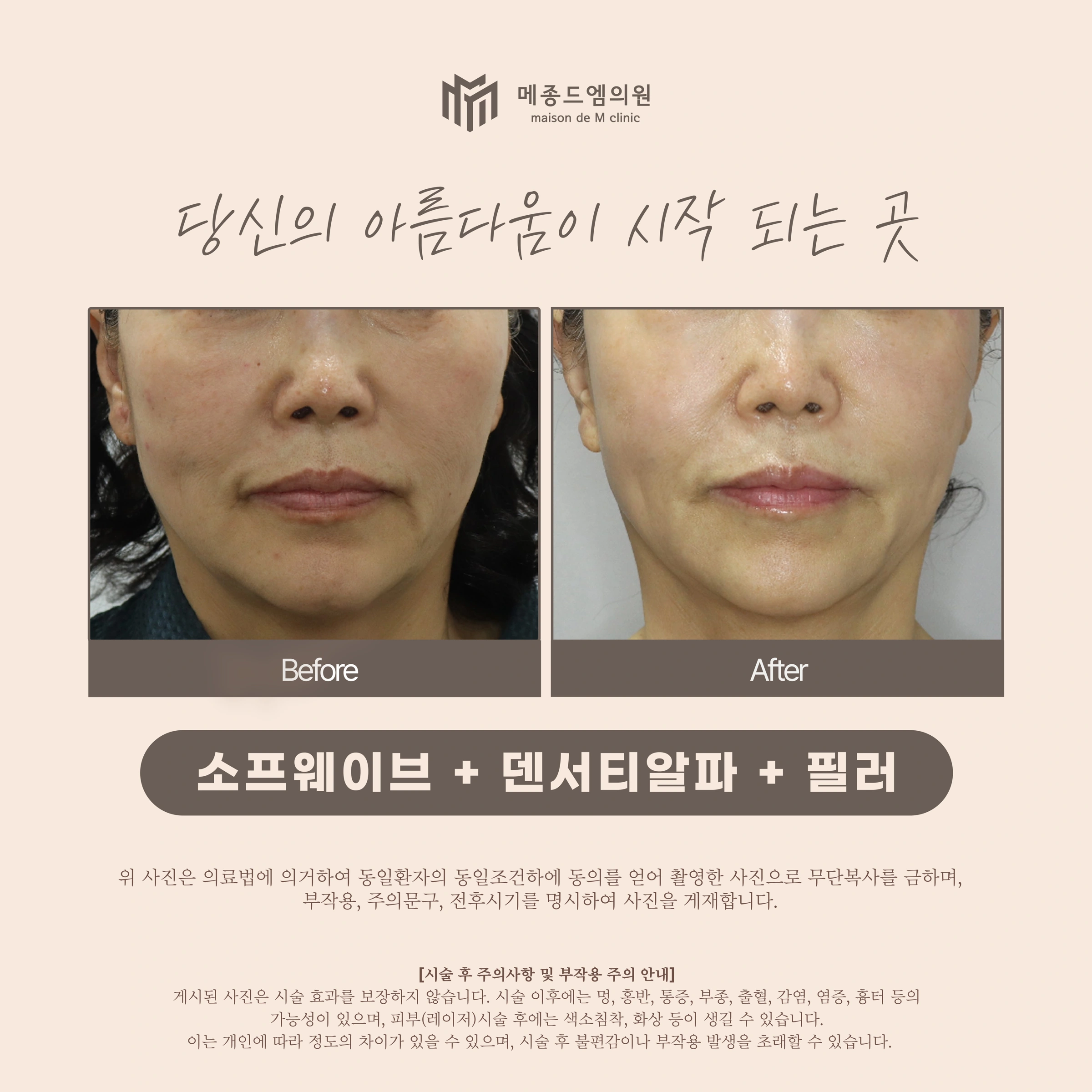 Sofwave, Density Alpha and filler at Maison de M Clinic. Maison de M Clinic: Sofwave, Density Alpha and filler. Before on the left; after on the right. Front views focus on the cheeks, folds beside the mouth and lower face. The head position and skin reflections differ.
