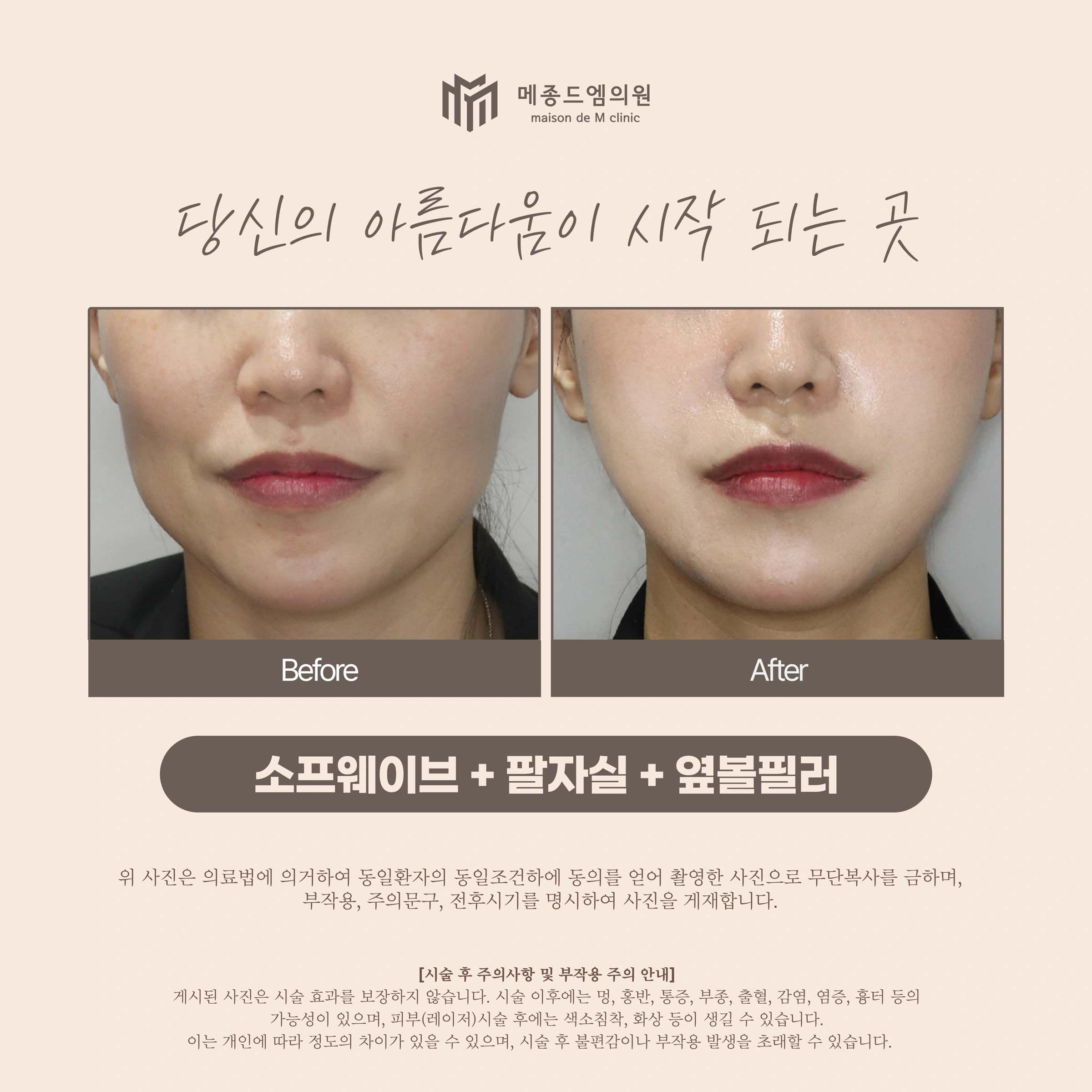 Sofwave, nasolabial threads and cheek filler at Maison de M Clinic. Maison de M Clinic: Sofwave, nasolabial threads and cheek filler. Before on the left; after on the right. The photographs show the front of the cheeks and mouth. Lip colour, expression and surface shine vary between the two views.