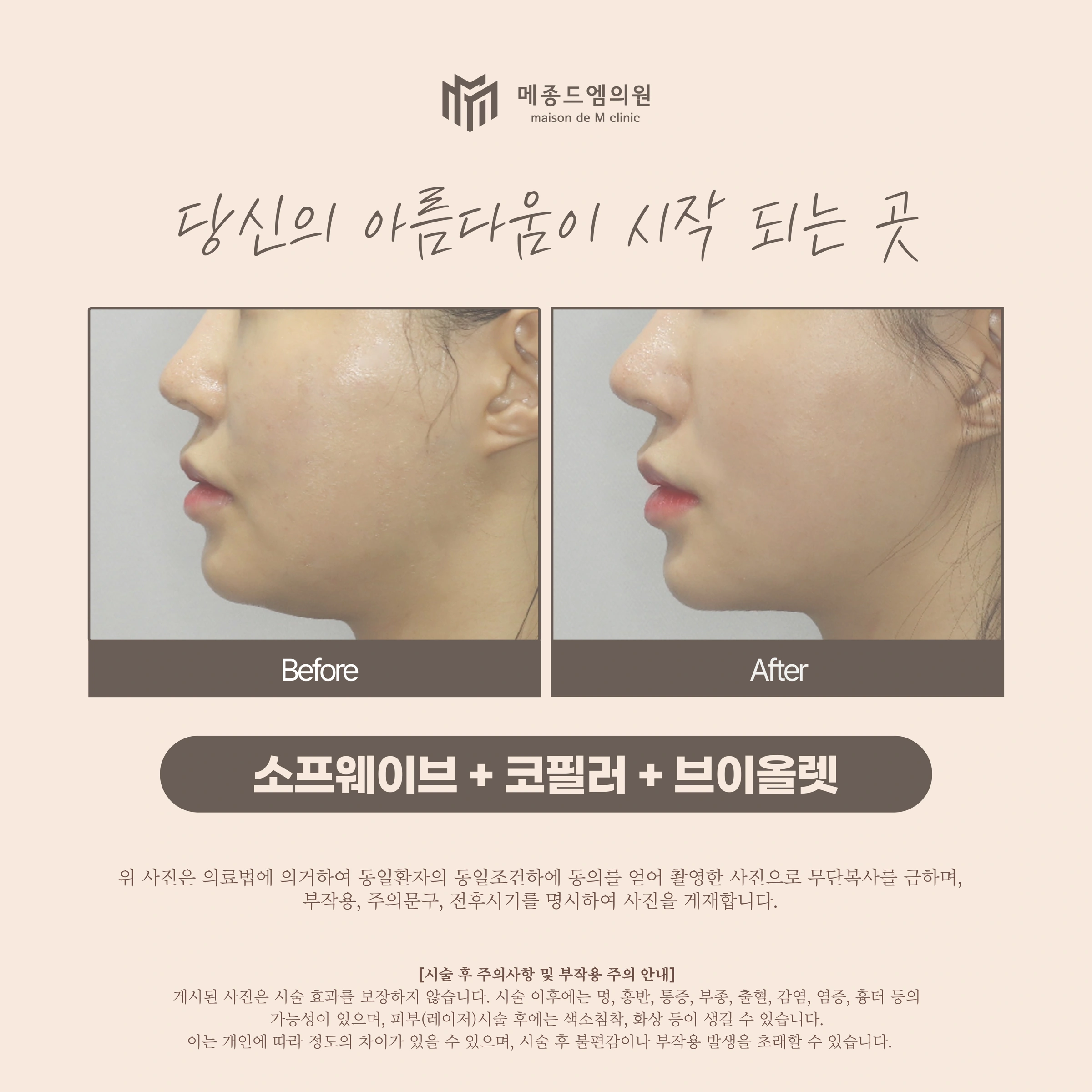Sofwave, nose filler and V-OLET at Maison de M Clinic. Maison de M Clinic: Sofwave, nose filler and V-OLET. Before on the left; after on the right. Profile views show the nose, chin and jawline. The clinic lists three treatments; the photographs cannot attribute the visible differences to one of them.
