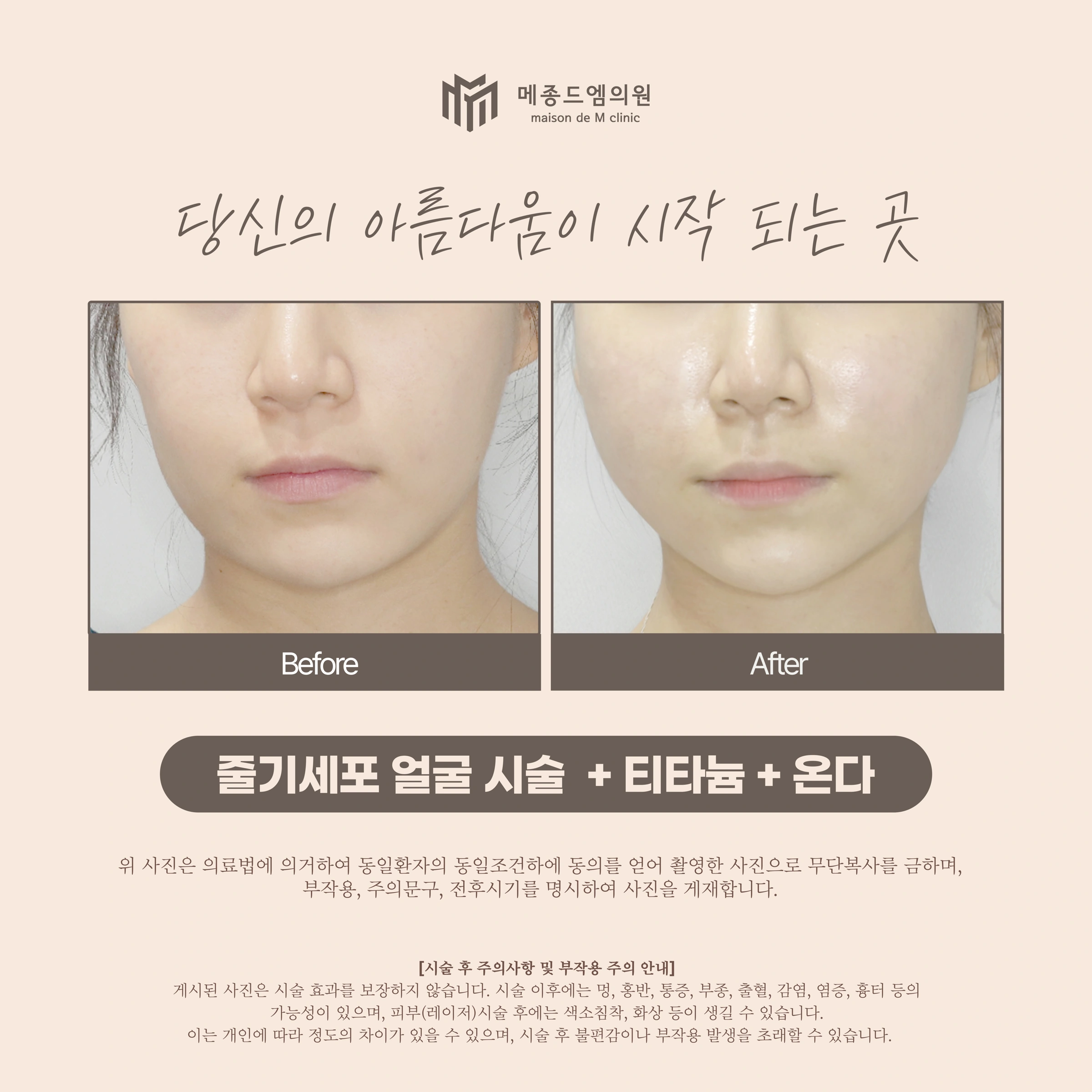 Facial stem-cell treatment, Titanium and Onda — comparison 01 at Maison de M Clinic. Maison de M Clinic: Facial stem-cell treatment, Titanium and Onda — comparison 01. Before on the left; after on the right. The frontal views include the cheeks, mouth and chin. The three-part treatment label does not identify the…