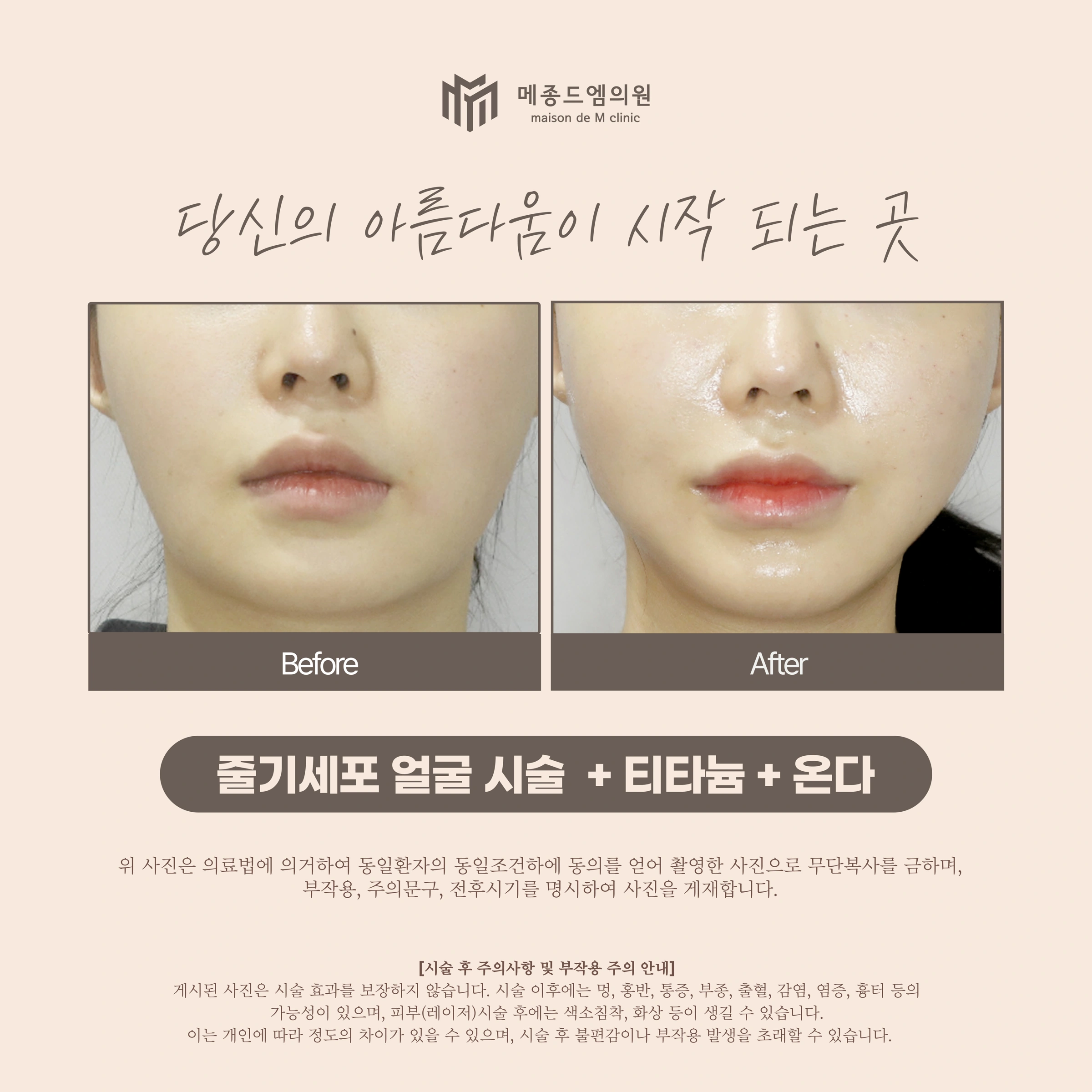 Facial stem-cell treatment, Titanium and Onda — comparison 02 at Maison de M Clinic. Maison de M Clinic: Facial stem-cell treatment, Titanium and Onda — comparison 02. Before on the left; after on the right. This second comparison shows the lower cheeks, lips and chin. The cell preparation and method are not…