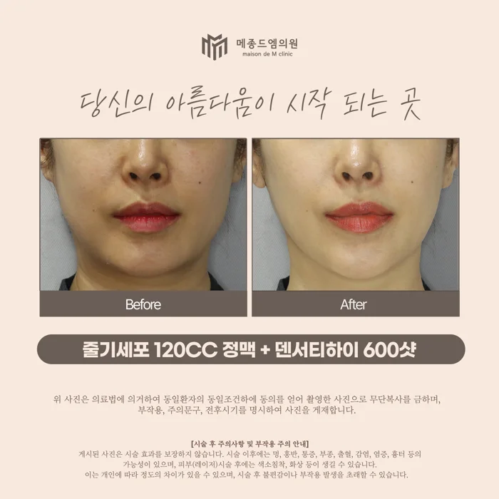 Stem-cell IV and Density High: a facial comparison at Maison de M Clinic. Before on the left; after on the right. The photographs show the cheek surface, folds beside the mouth, chin and jawline. Lip colour and lighting differ. Because the clinic lists two treatments together, these photographs do not isolate the…