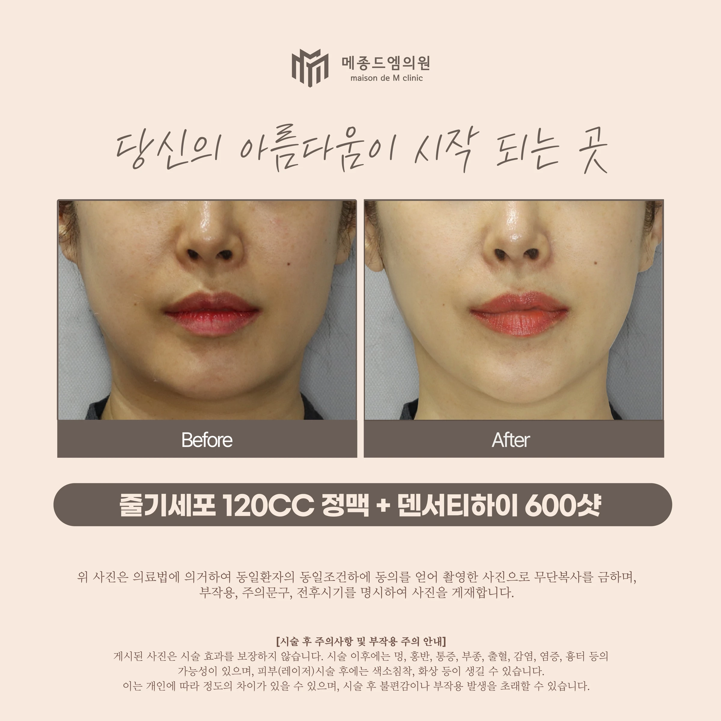 Stem-cell IV and Density High: a facial comparison at Maison de M Clinic. Before on the left; after on the right. The photographs show the cheek surface, folds beside the mouth, chin and jawline. Lip colour and lighting differ. Because the clinic lists two treatments together, these photographs do not isolate the…