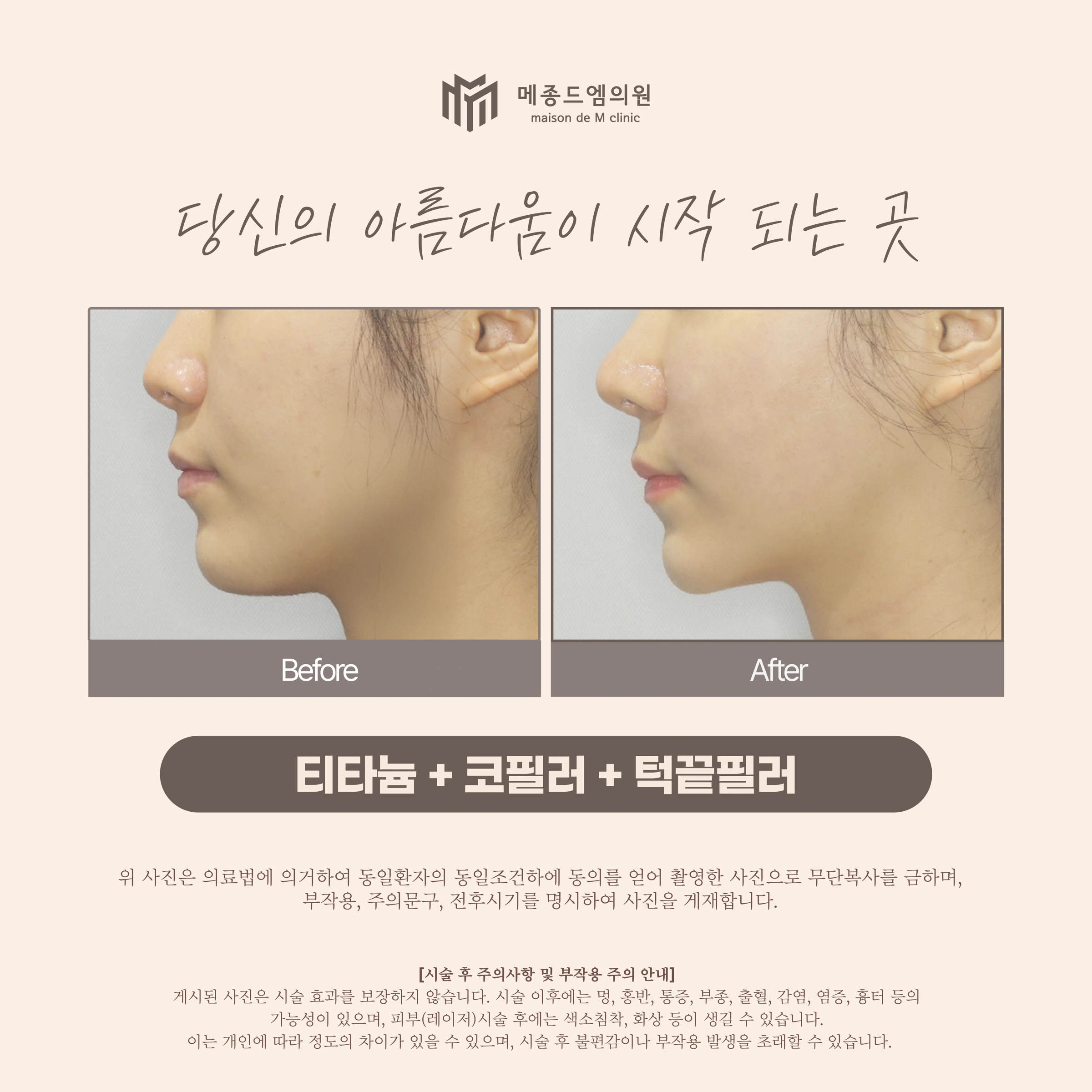 Titanium with nose and chin filler at Maison de M Clinic. Maison de M Clinic: Titanium with nose and chin filler. Before on the left; after on the right. Profile photographs show the nose and chin outline. Different head positions and lighting should be considered when looking at projection.