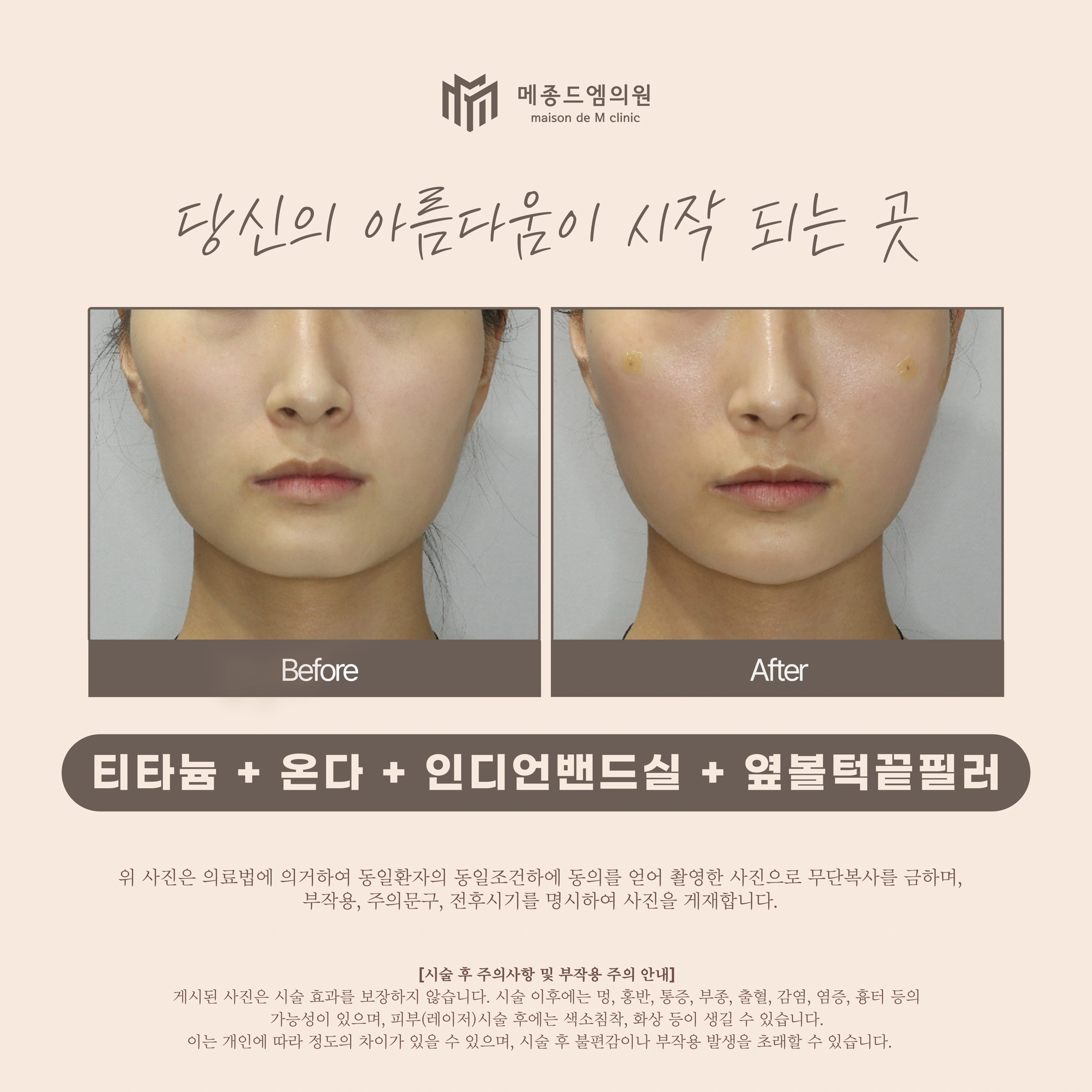 Titanium, Onda, mid-cheek threads and filler at Maison de M Clinic. Maison de M Clinic: Titanium, Onda, mid-cheek threads and filler. Before on the left; after on the right. The front-facing photographs show the cheeks and jawline. Small dressings are visible in the after photograph. Its appearance does not establish…