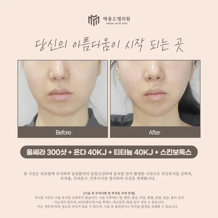 Ultherapy, Onda, Titanium and skin Botox at Maison de M Clinic. Before on the left; after on the right. The paired front views show the cheeks beside the mouth and the outline running from the lower cheeks to the chin. The after photograph has a more reflective skin surface; this affects how highlights and texture…