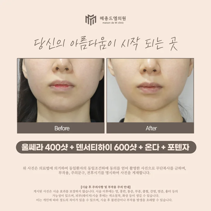 Ultherapy, Density High, Onda and Potenza at Maison de M Clinic. Before on the left; after on the right. The front views include the cheek contours, corners of the mouth, chin and jawline. The head position differs slightly between views, which changes the visible outline beneath the chin.