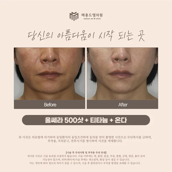Ultherapy 500 shots with Titanium and Onda at Maison de M Clinic. Before on the left; after on the right. Compare the folds beside the nose and mouth and the lower cheek outline. Skin redness and surface texture are visible in both photographs, with differences in lighting and skin appearance.