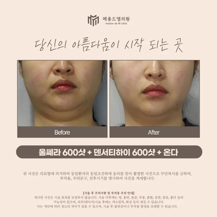 Ultherapy 600 shots with Density High and Onda at Maison de M Clinic. Before on the left; after on the right. Look at the lower cheek outline and the transition from the chin to the upper neck. A slight difference in head angle and shadows beneath the chin should be considered when comparing the two views.