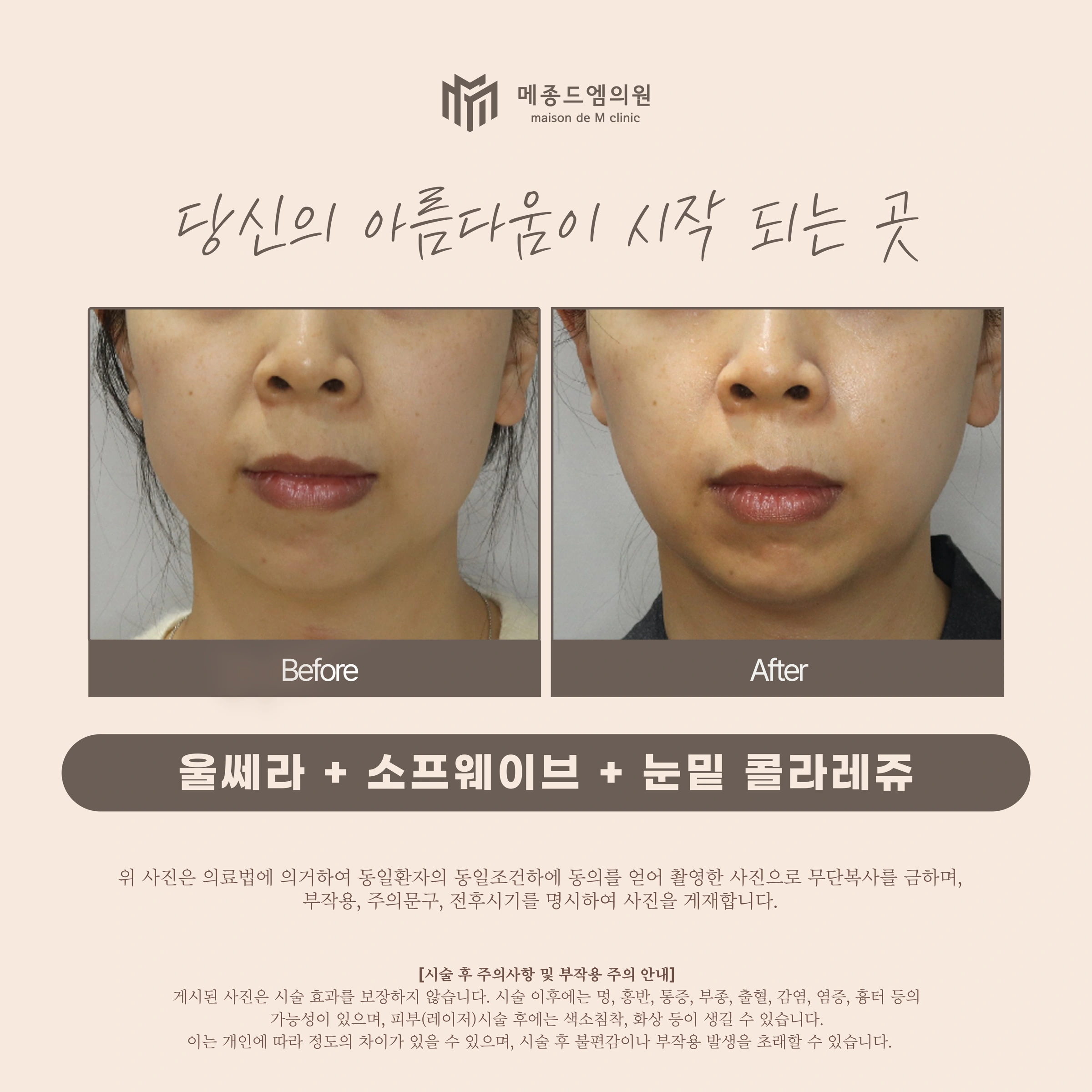 Ultherapy, Sofwave and under-eye Collaju at Maison de M Clinic. Maison de M Clinic: Ultherapy, Sofwave and under-eye Collaju. Before on the left; after on the right. Front-facing views show the cheeks and lower face after a combined treatment. The under-eye area is mostly outside the frame, so this crop does not…