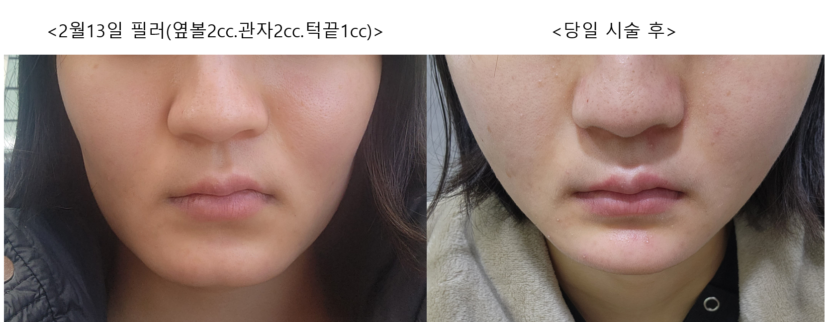 Facial filler — cheeks, temples and chin at Mason Clinic. Mason Clinic, Seoul: Facial filler — cheeks, temples and chin. Clinic-supplied comparison board. Immediately after treatment, February 13