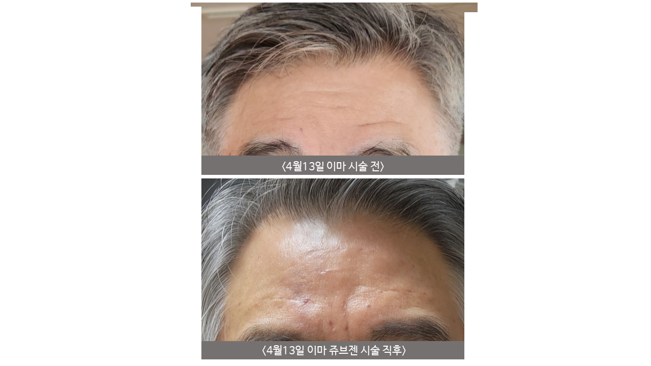 Forehead and glabella Juvegen at Mason Clinic. Mason Clinic, Seoul: Forehead and glabella Juvegen. Clinic-supplied comparison board. Immediately after treatment, April 13