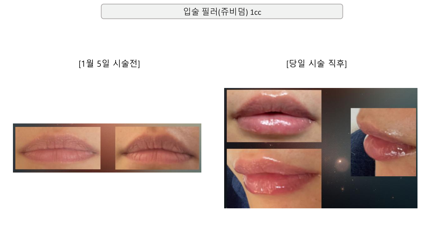 Juvederm lip filler — January comparison at Mason Clinic. Mason Clinic, Seoul: Juvederm lip filler — January comparison. Clinic document, page 16. Immediately after treatment, January 5
