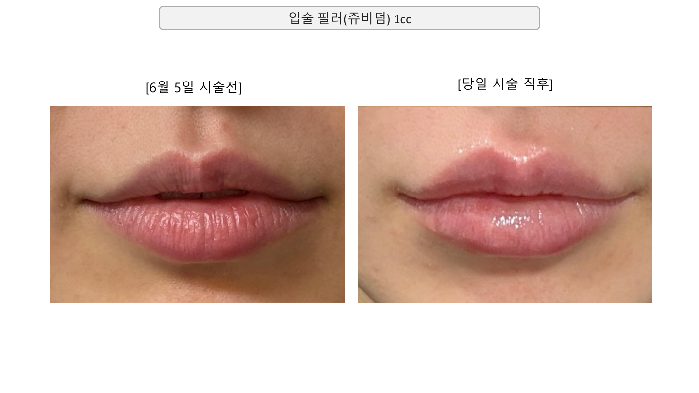 Juvederm lip filler — June comparison at Mason Clinic. Mason Clinic, Seoul: Juvederm lip filler — June comparison. Clinic document, page 15. Immediately after treatment, June 5