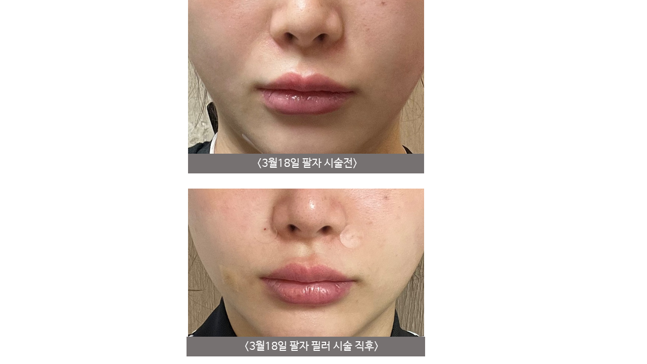 Nasolabial filler — 1 cc at Mason Clinic. Mason Clinic, Seoul: Nasolabial filler — 1 cc. Clinic-supplied comparison board. Immediately after treatment, March 18