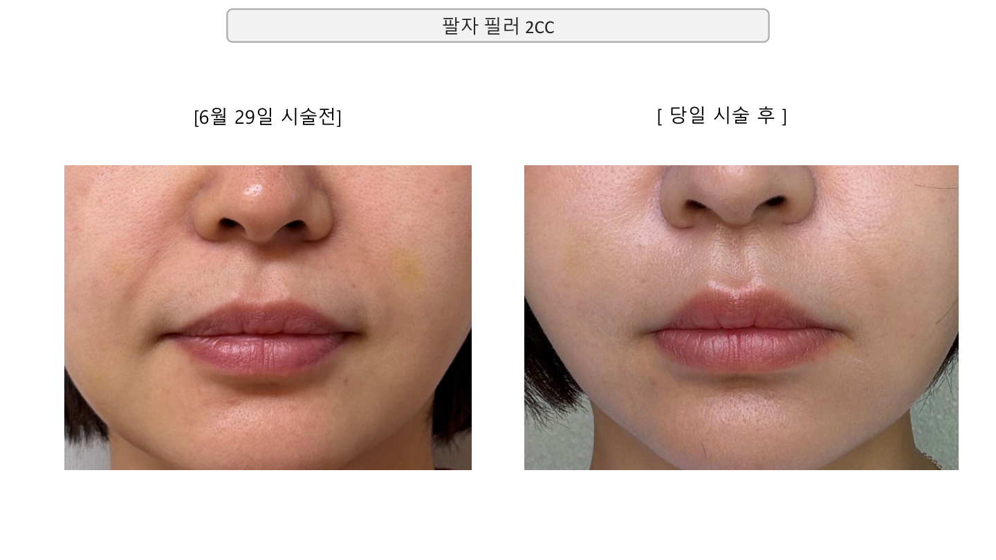 Nasolabial filler — 2 cc at Mason Clinic. Mason Clinic, Seoul: Nasolabial filler — 2 cc. Clinic document, page 14. Same day, June 29