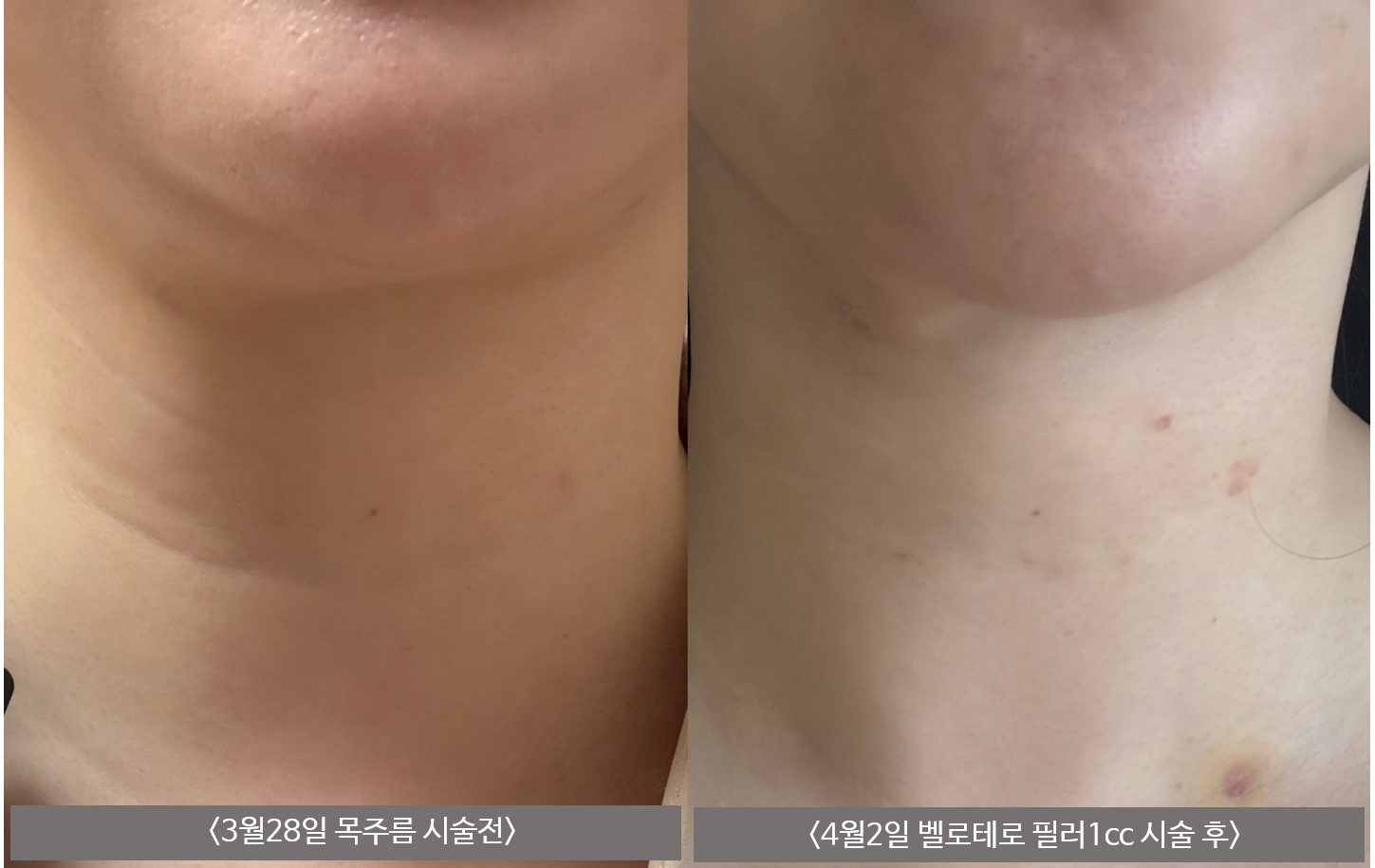 Neck-line filler — staged follow-up at Mason Clinic. Mason Clinic, Seoul: Neck-line filler — staged follow-up. Clinic-supplied comparison board. Five days and after a second session