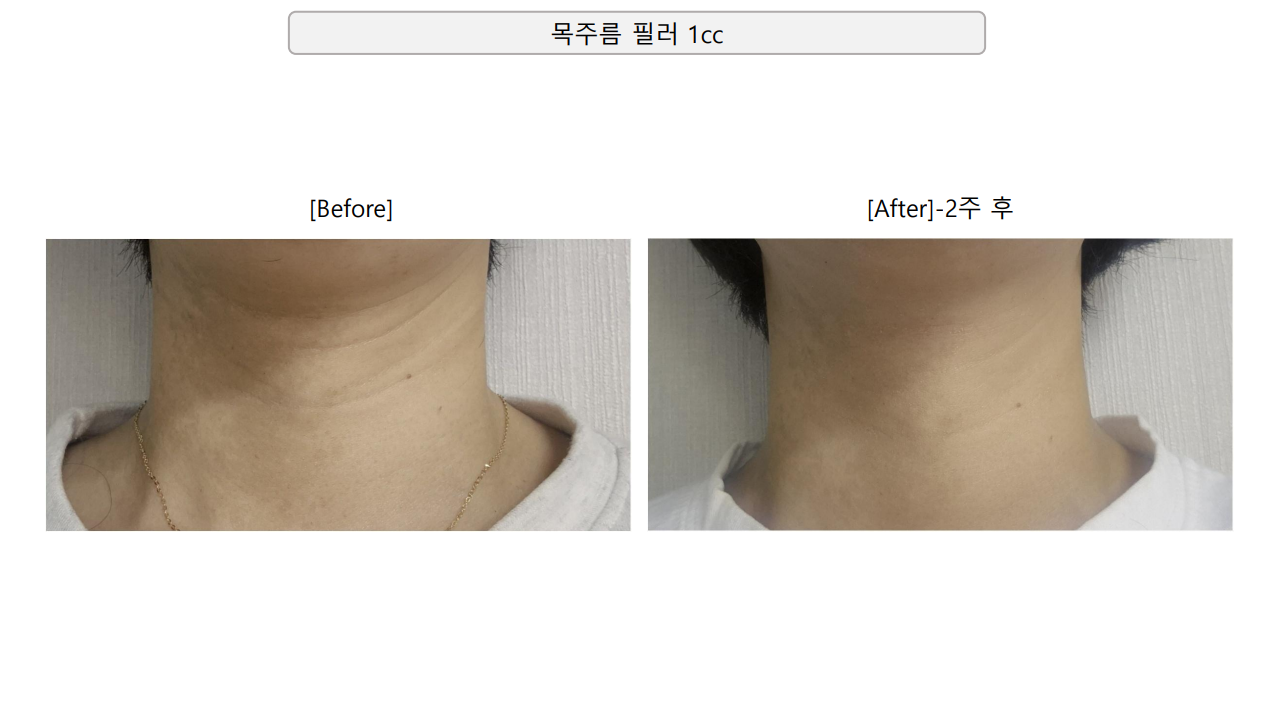 Neck-line filler — two weeks at Mason Clinic. Mason Clinic, Seoul: Neck-line filler — two weeks. Clinic-supplied comparison board. Two weeks