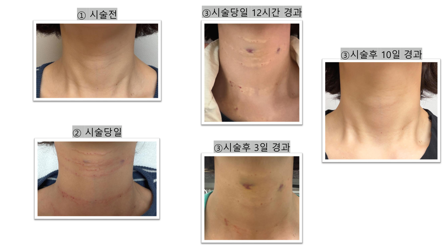 Neck treatment — ten-day photo sequence at Mason Clinic. Mason Clinic, Seoul: Neck treatment — ten-day photo sequence. Clinic document, page 5. Treatment day to ten days